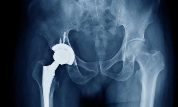 Device Maker Gains Defense Verdict in Hip Implant Case